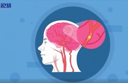 健康問(wèn)答 | 關(guān)于腦中風(fēng)，患者家屬有哪些常見誤區(qū)？