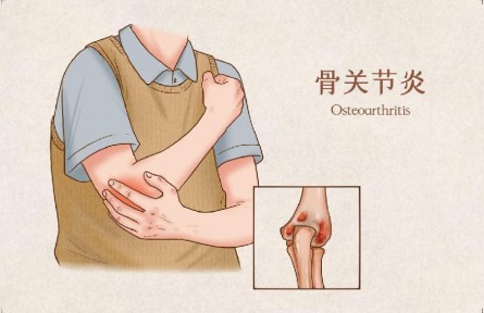 生活中怎樣預防骨關(guān)節(jié)炎？