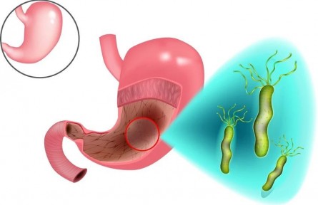 守“胃”健康，這些護(hù)胃措施請收好