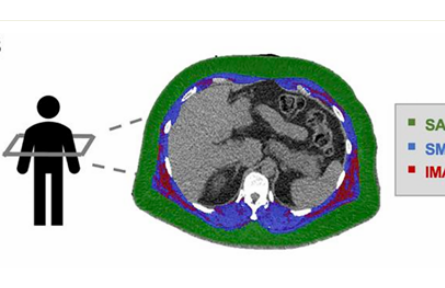 骨骼肌肌間脂肪多，心血管病風(fēng)險高