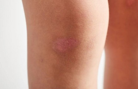 辟謠|疤痕膏可以完全祛除疤痕？